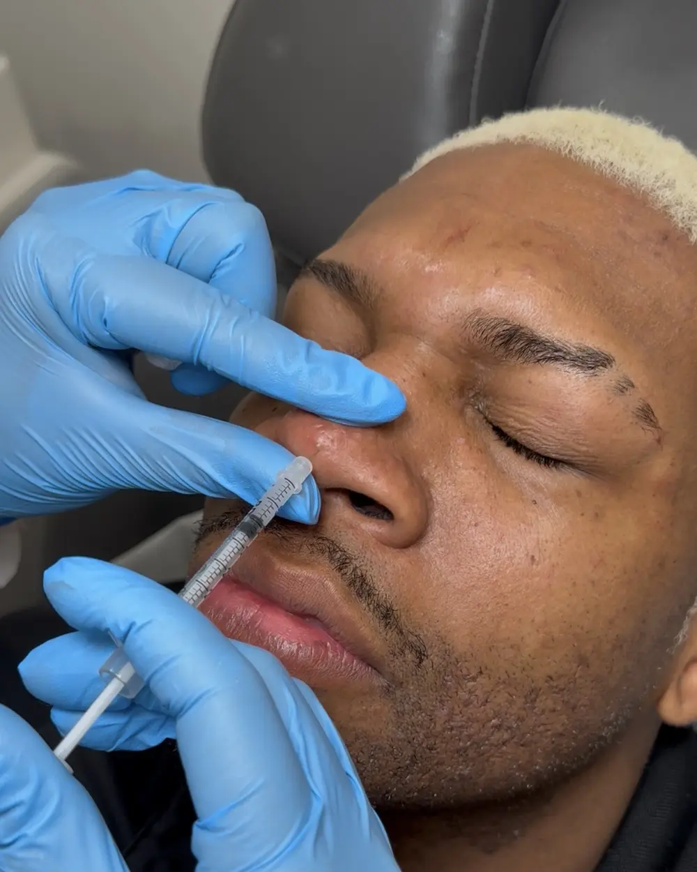 Corticosteroid acne shot placed into a cystic acne lesion at Annaré, Tarzana CA