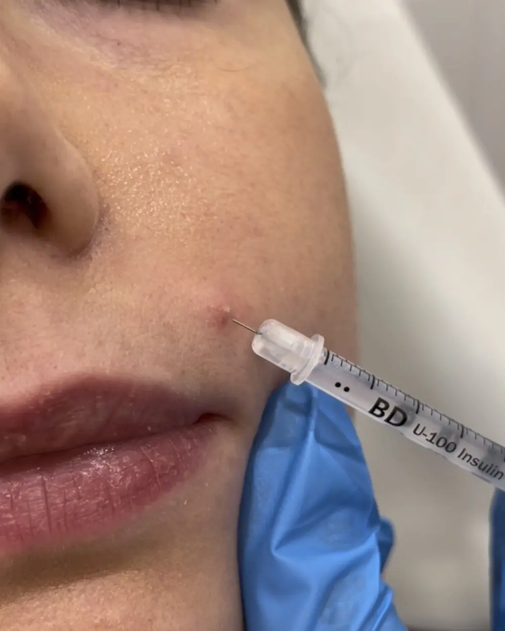 Corticosteroid acne shot injected into an inflamed blemish at Annaré, Tarzana CA