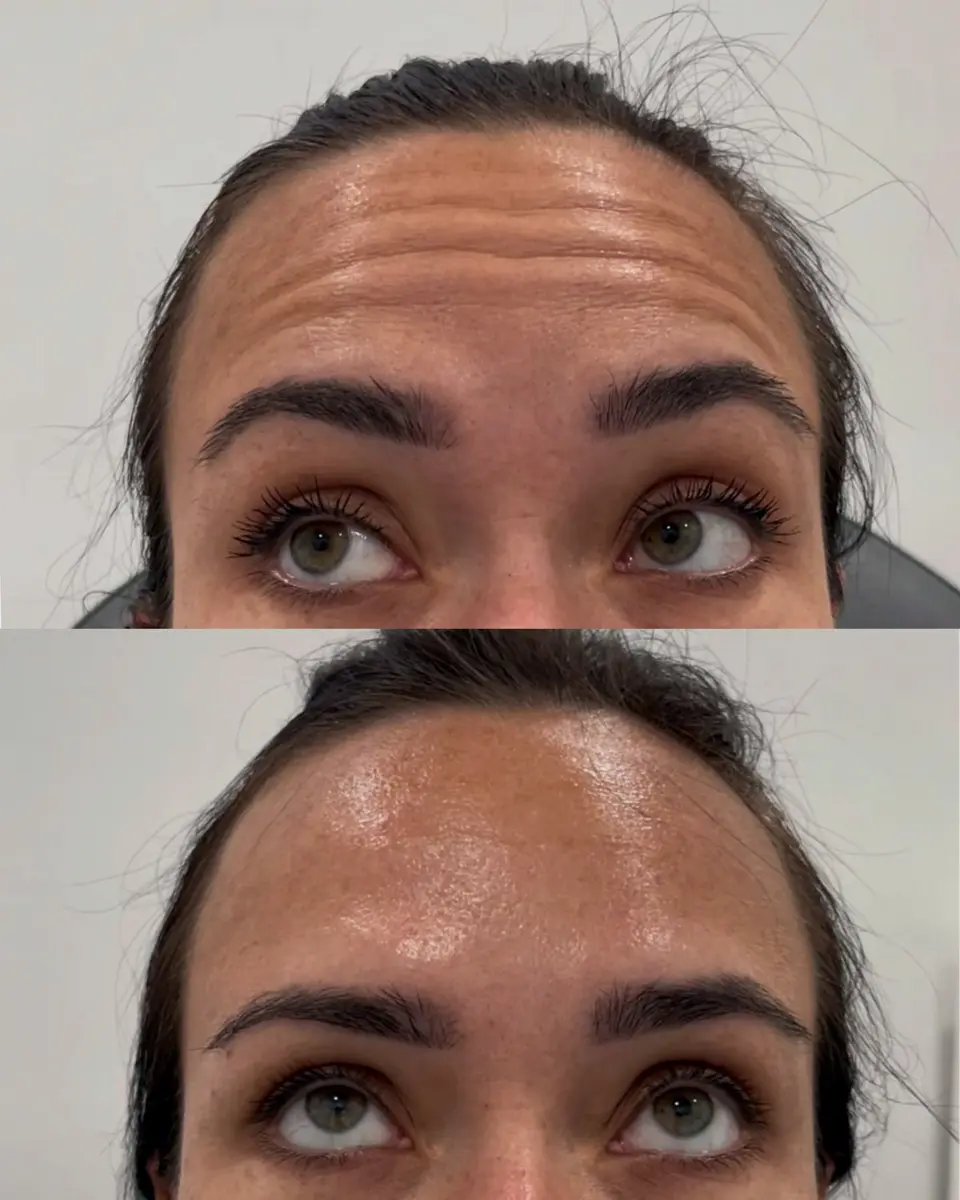 Botox before and after on forehead lines, Tarzana CA