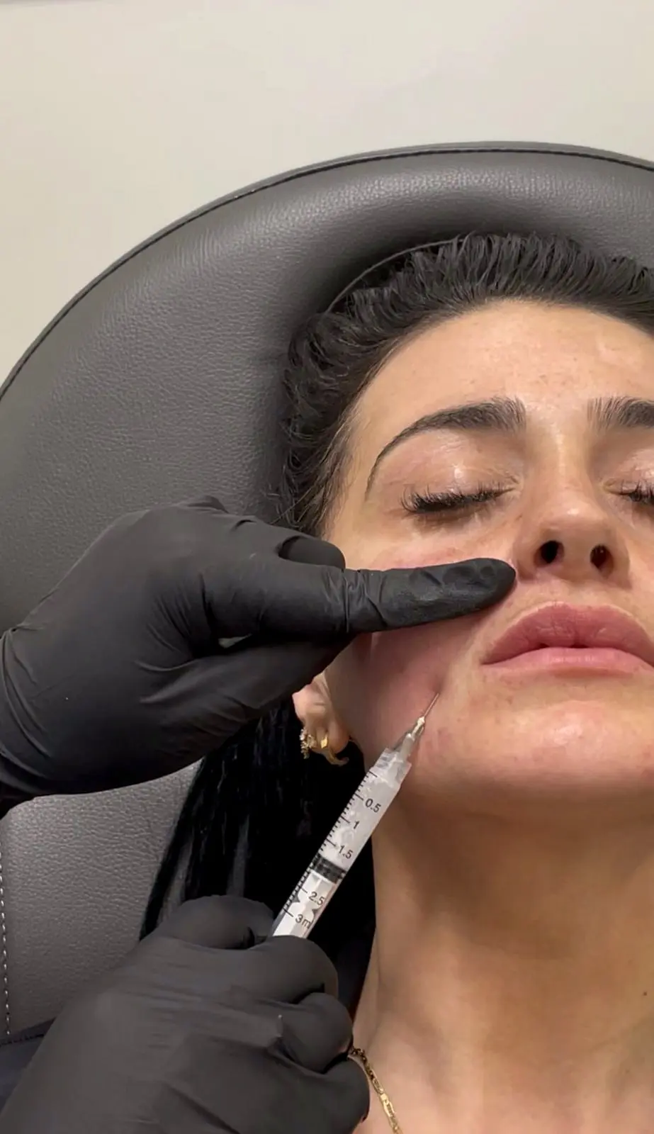 Sculptra biostimulator injection into the cheek, Tarzana CA