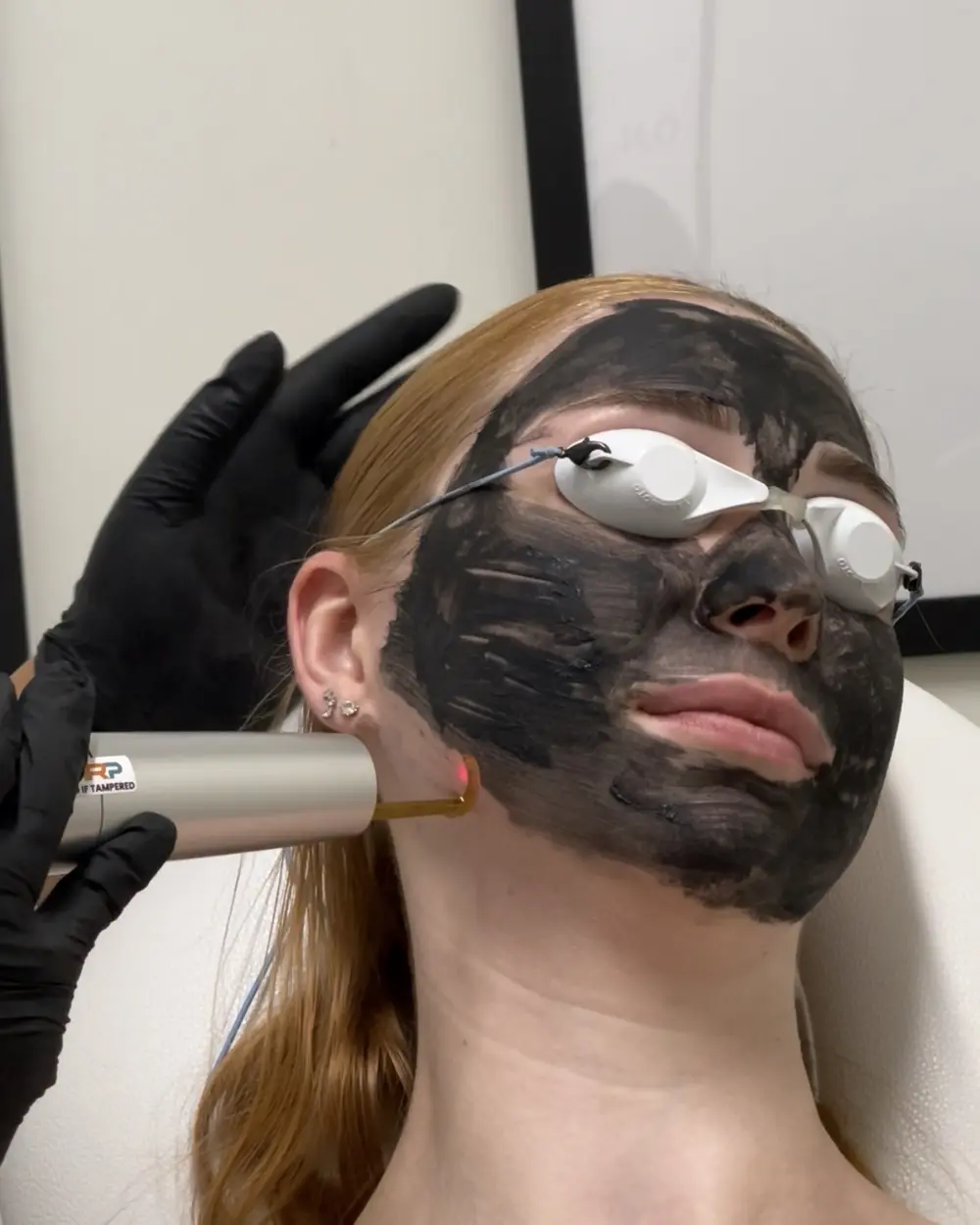 Carbon peel laser treatment over a carbon mask at Annaré, Tarzana CA
