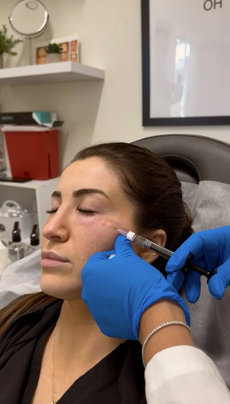 Injectable skin hydration with hyaluronic acid skin boosters at Annaré, Tarzana CA