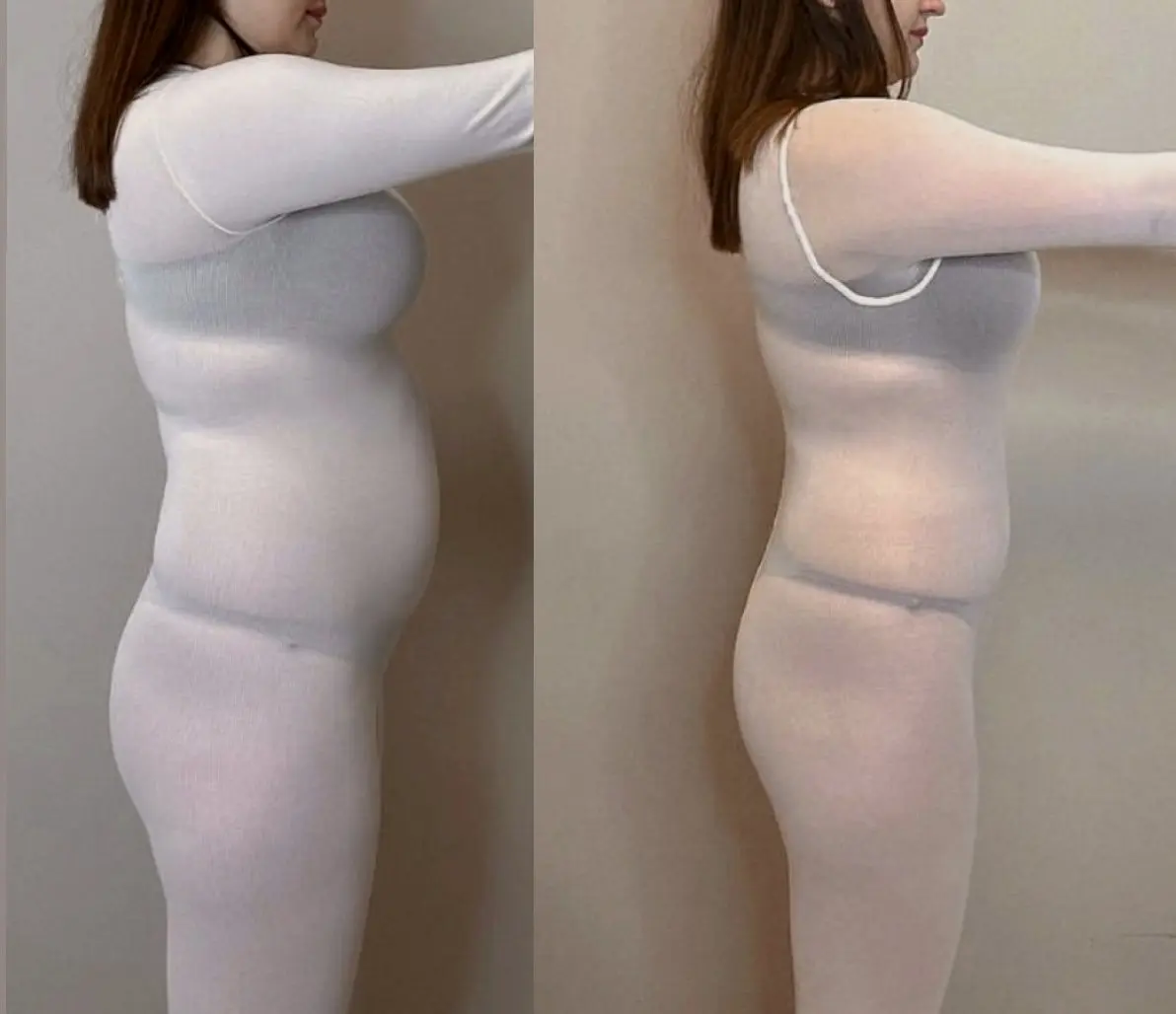Icoone body contouring results after ten sessions at Annaré, Tarzana CA