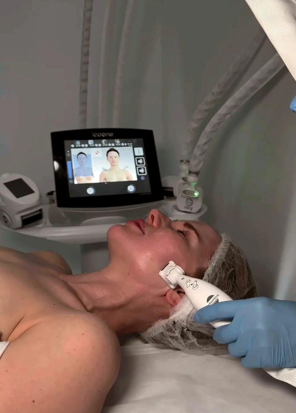 Icoone body contouring treatment, Tarzana CA