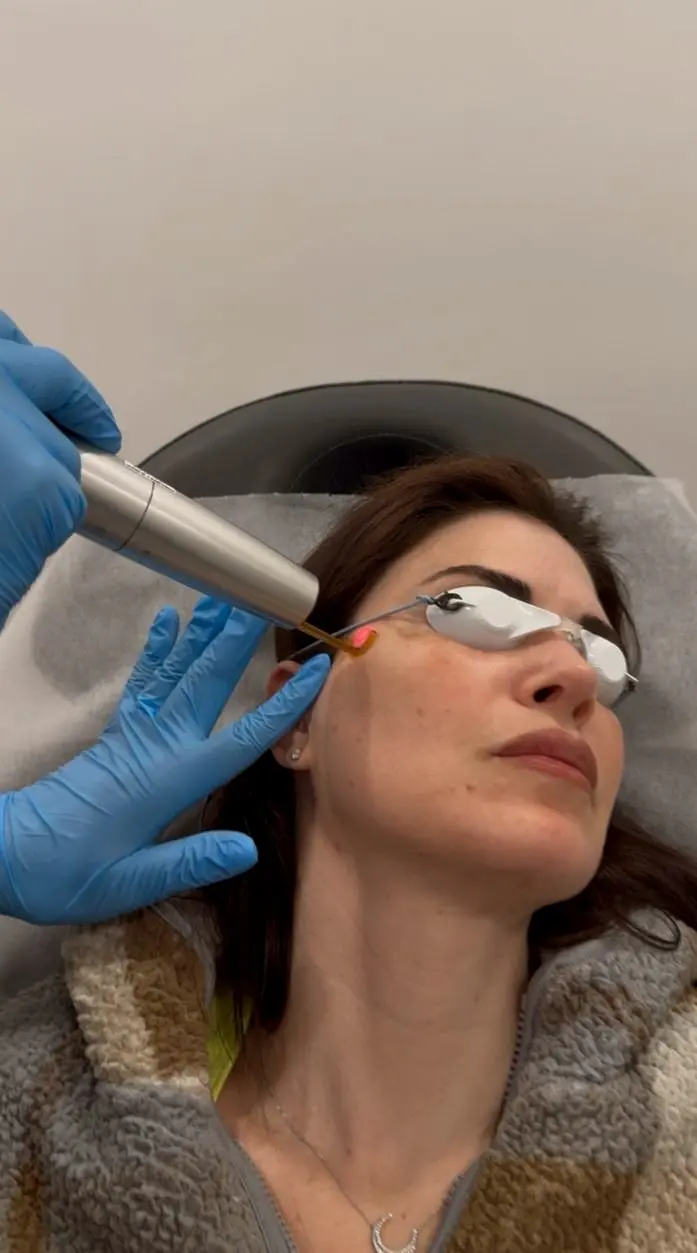 Pico laser skin treatment for pigmentation, Tarzana CA