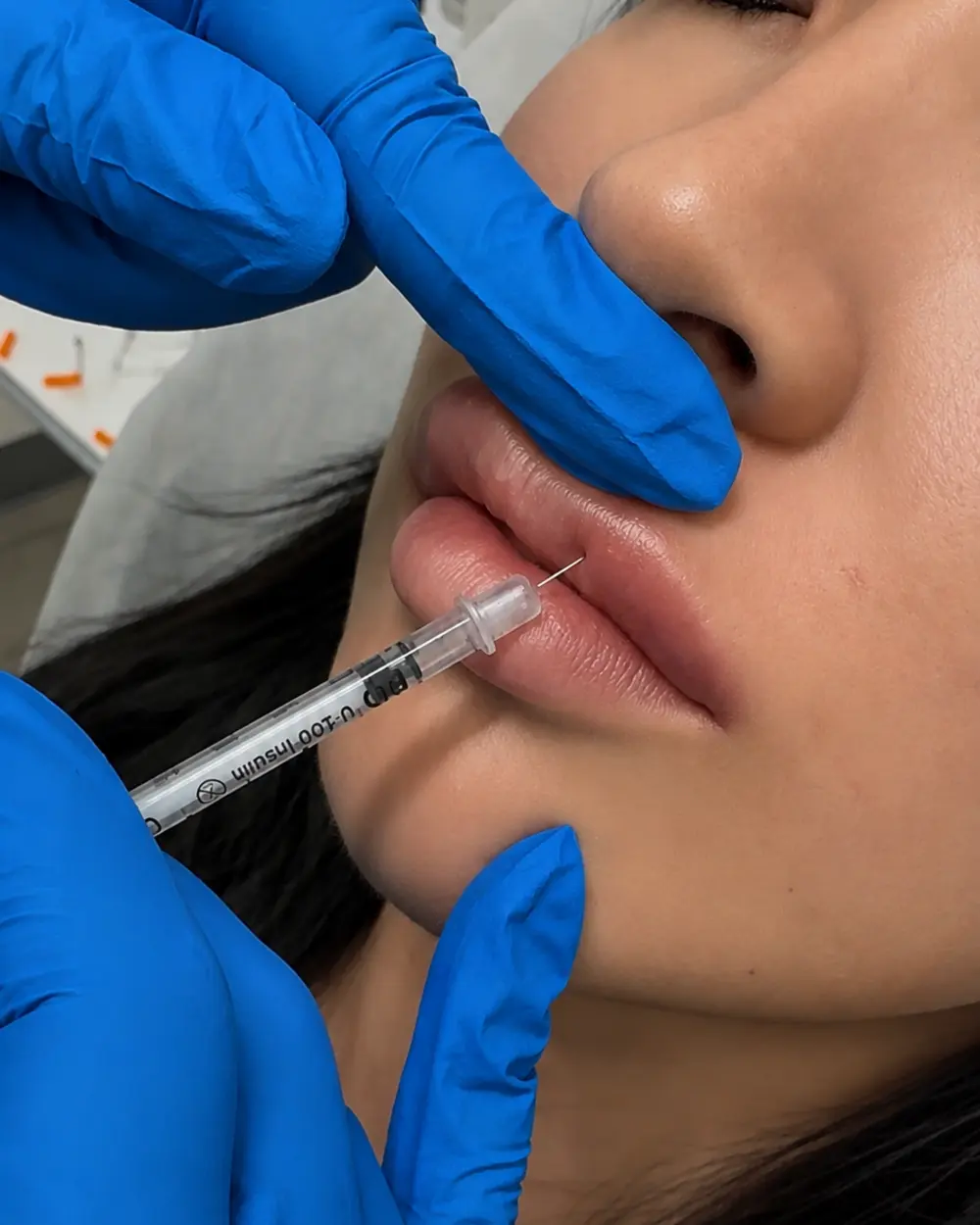 Hyaluronidase injected into the lip to dissolve hyaluronic acid filler at Annaré, Tarzana CA