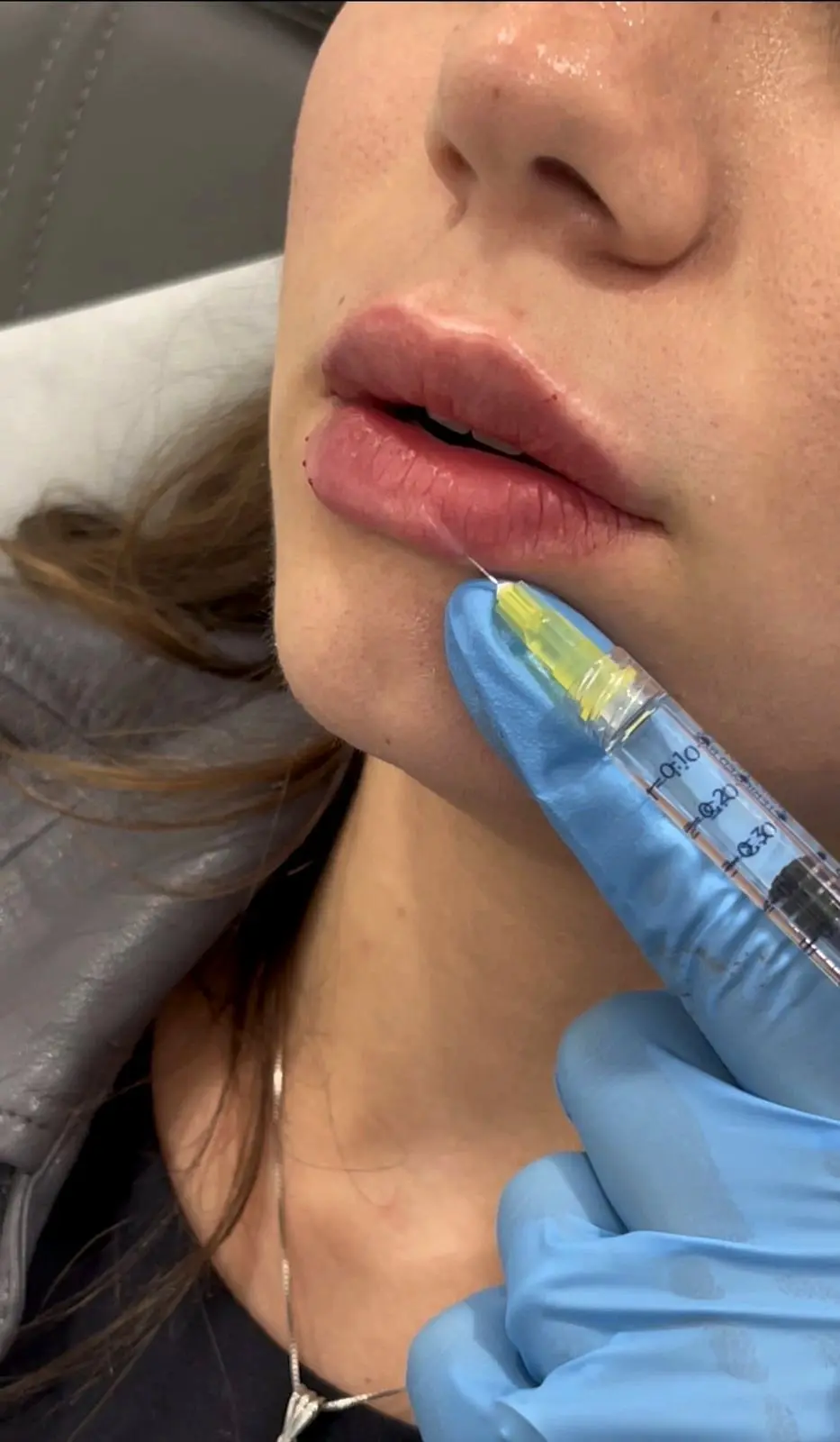 Lip filler injection HA fillers, San Fernando Valley