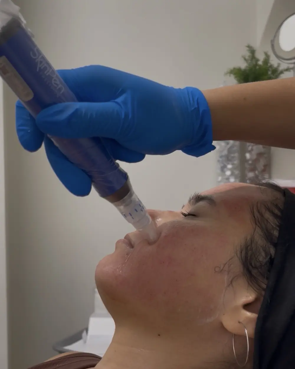 Microneedling with the SkinPen across the cheek at Annaré, Tarzana CA