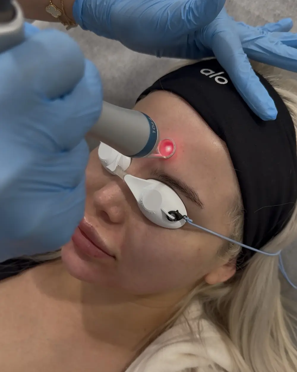 Pico laser pass across the forehead with eye shields in place at Annaré, Tarzana CA
