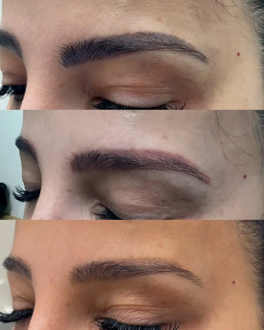 PMU brow removal before and after three laser sessions at Annaré, Tarzana CA