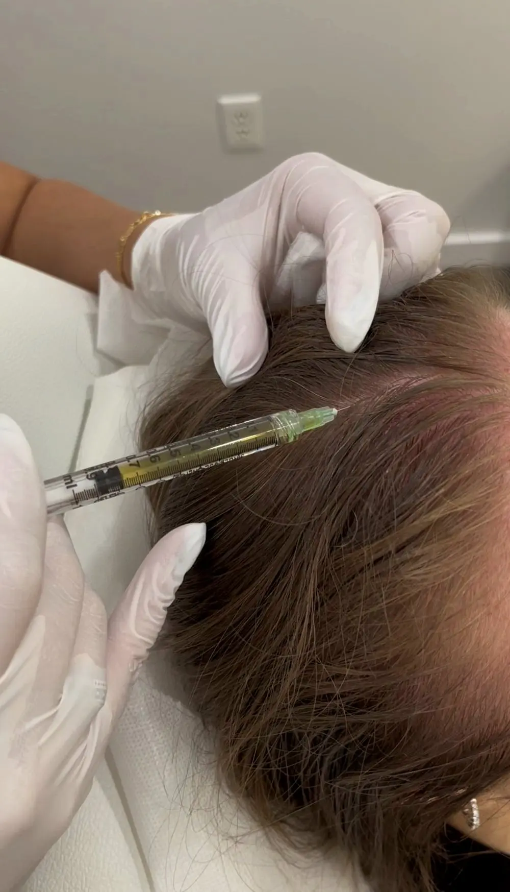 PRP hair growth injection into the scalp at Annaré, Tarzana CA