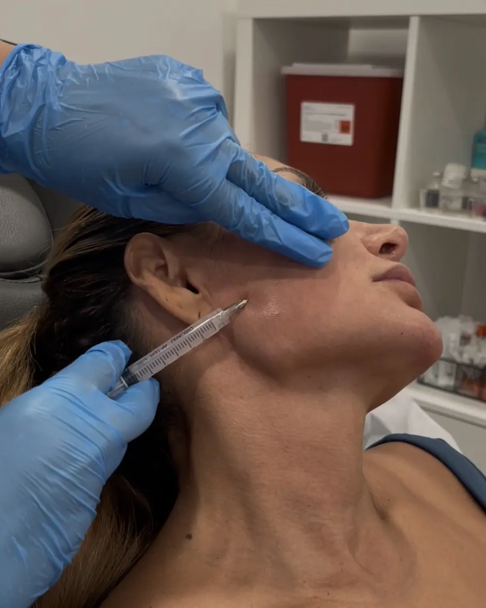 Sculptra biostimulator injected along the jawline at Annaré, Tarzana CA