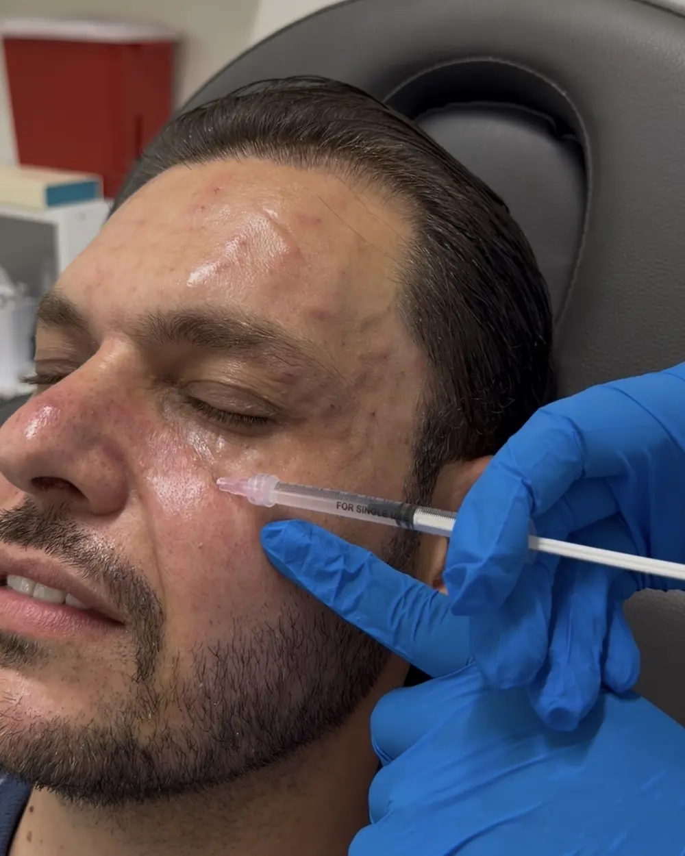 Skin booster injected into the under-eye area at Annaré, Tarzana CA