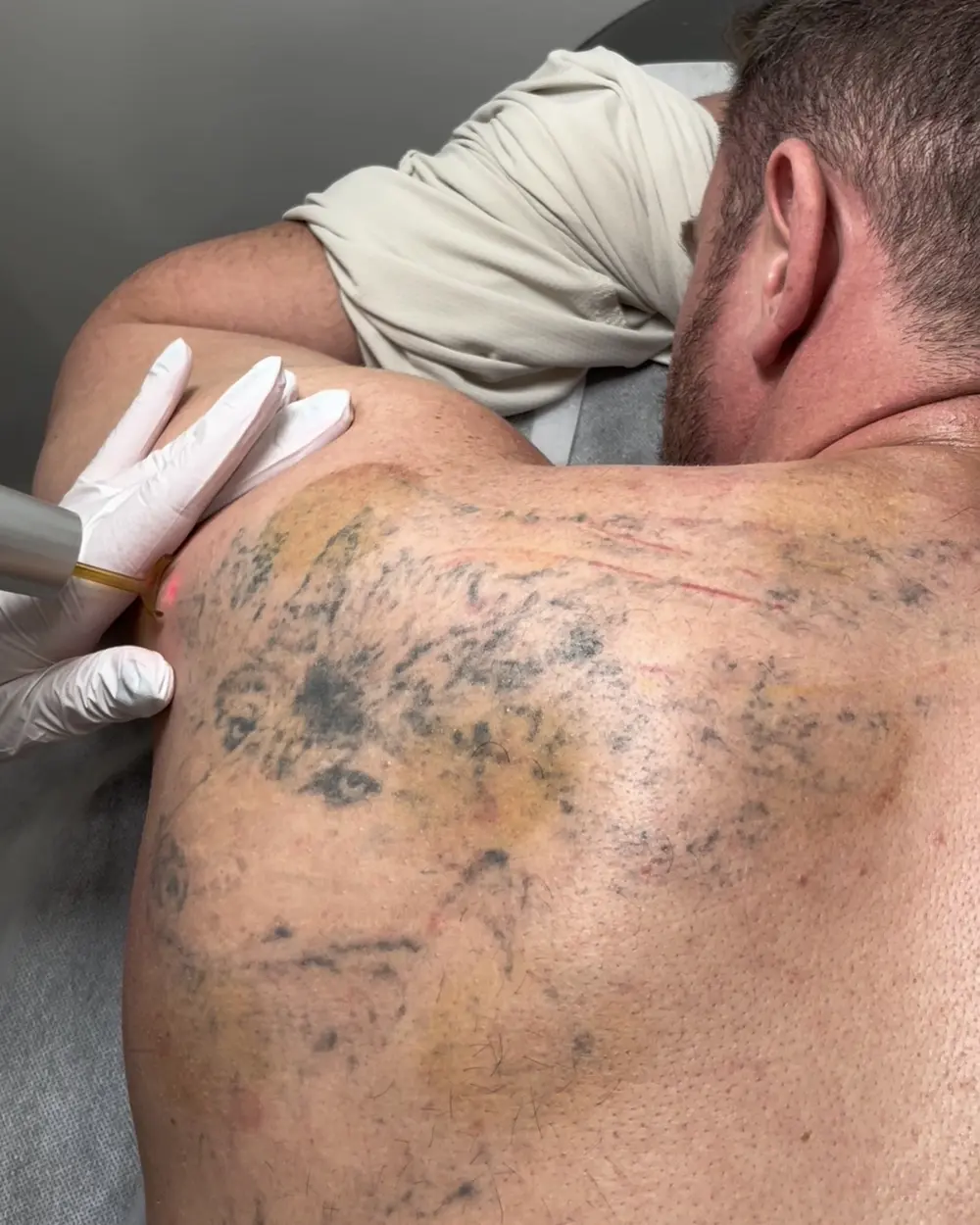 Laser tattoo removal on a faded back and shoulder tattoo at Annaré, Tarzana CA