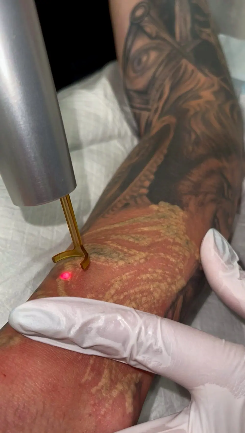 Laser tattoo removal treatment in progress at Annaré, Tarzana CA