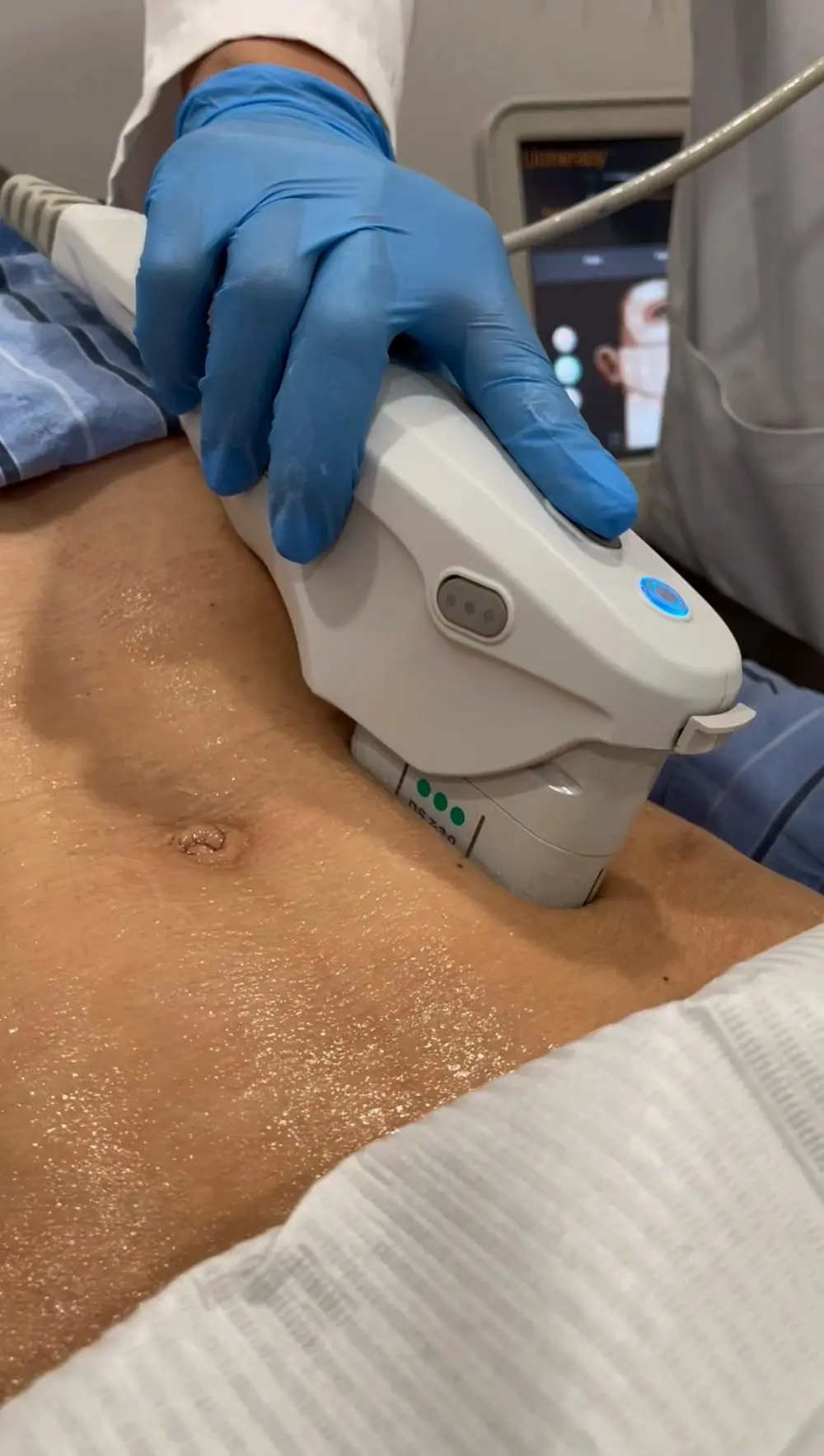 Ultherapy skin tightening along the jawline, Tarzana CA